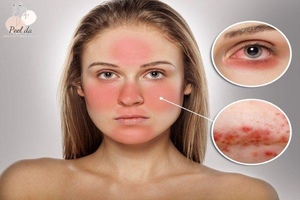 Kích ứng da là tác hại khi dùng nước tẩy trang Loreal fake